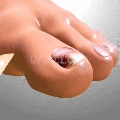 Plasturi pentru regenerarea unghiilor